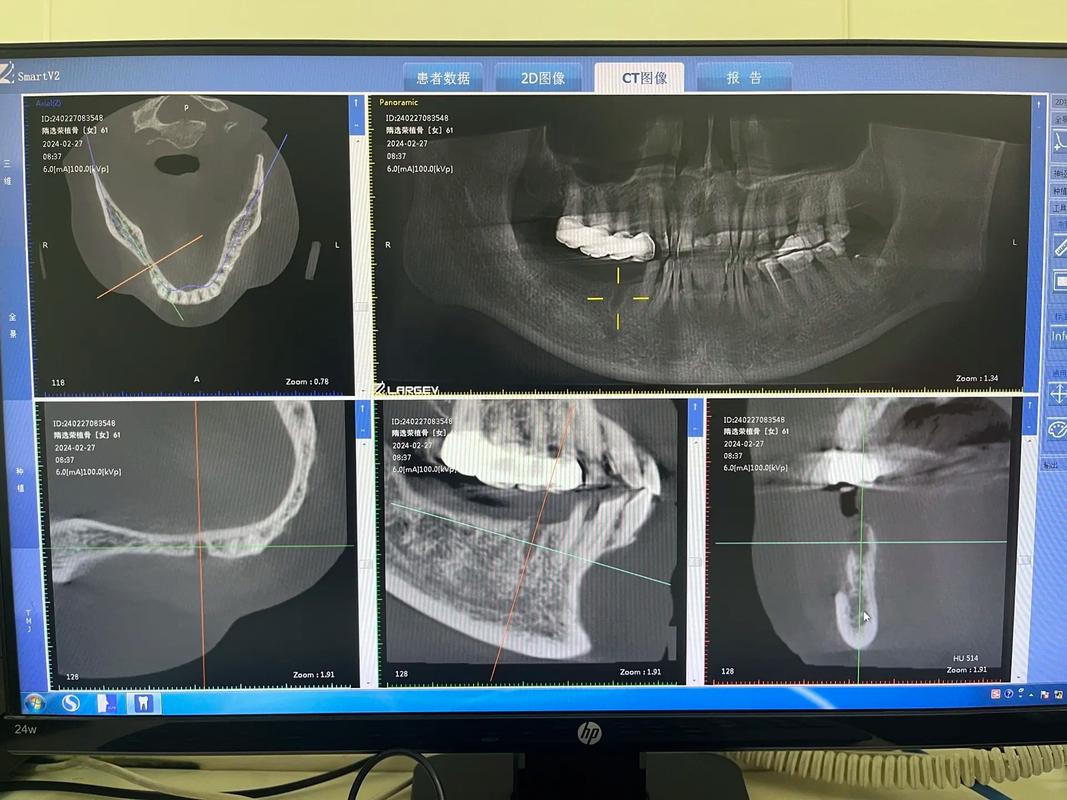 植骨后到底多久才能开始正畸？骨愈合周期、骨质条件会影响矫正时机吗？-图3