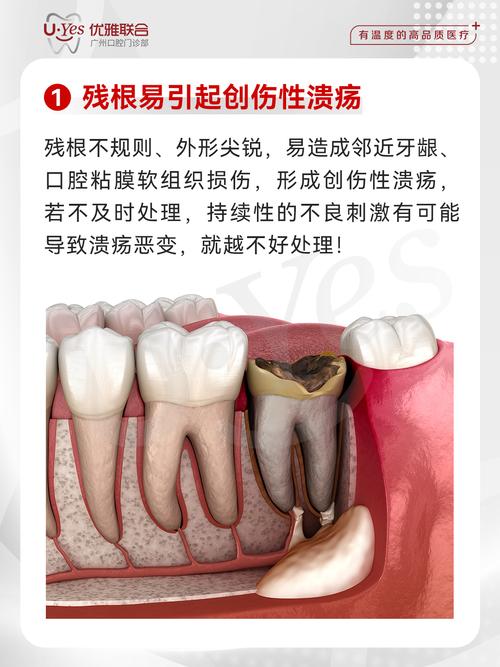 正畸治疗为何会导致牙坏死?探究其发生机制、风险因素及预防措施-图1 正畸治疗为何会导致牙坏死?探究其发生机制、风险因素及预防措施-图1