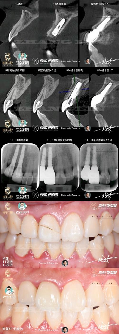 牙冠折患者正畸治疗中延长牙冠距离的适应症与临床效果如何评估？-图3