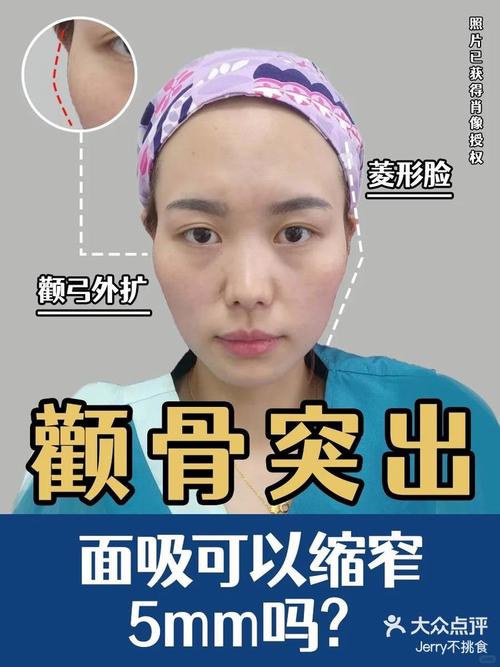 颧骨宽大的人群正畸真的能改善面型吗？会不会因颧骨条件限制效果？医生如何制定个性化方案？-图2