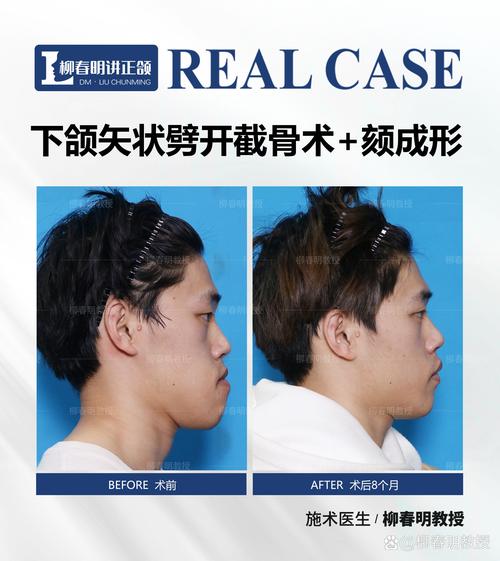 颧骨宽大的人群正畸真的能改善面型吗？会不会因颧骨条件限制效果？医生如何制定个性化方案？-图3