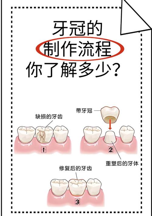 冠牙炎有哪些治疗方法？不同严重程度下如何选择治疗方式？日常护理对治疗效果有何影响？-图1
