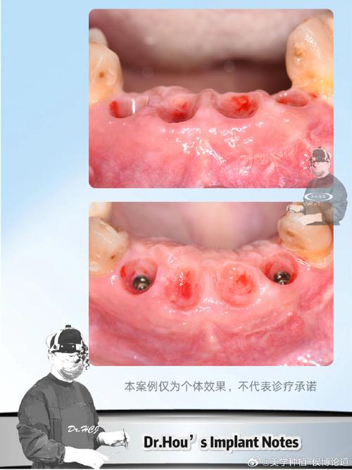 种植体松动是什么原因导致的？出现松动后该如何处理才能避免种植牙失败？-图2