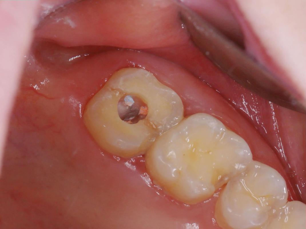 牙槽突裂的治疗方法有哪些？不同修复方式的效果与适用情况如何？-图1