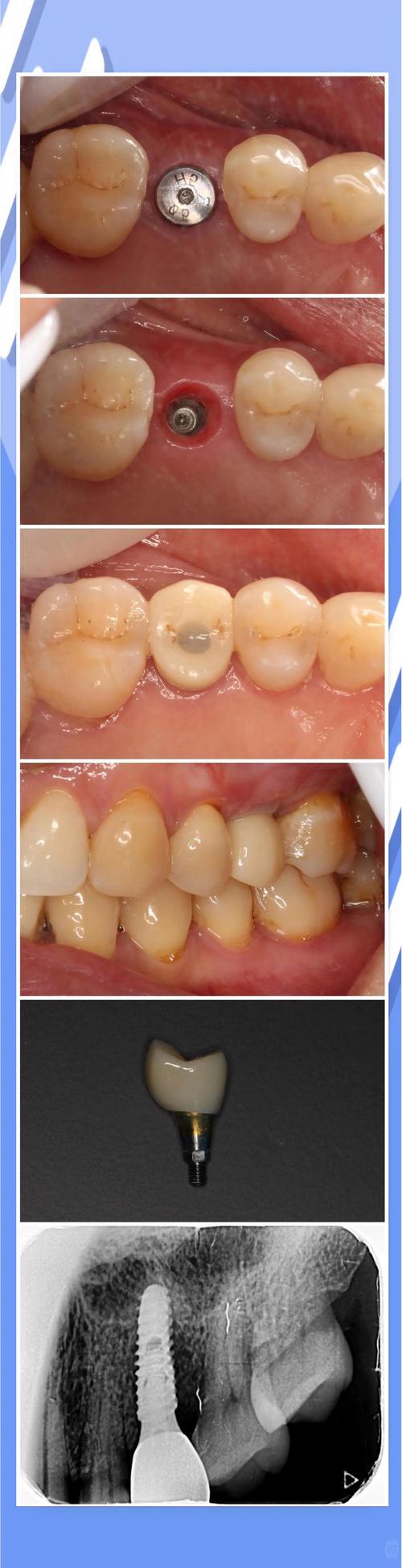 种牙种植体愈效果-图2