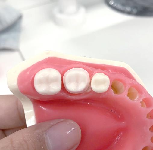 牙体预备定深方法有哪些常见类型？不同修复体类型（如全冠、嵌体）如何选择最优定深策略以确保边缘适配性与牙髓安全？-图3