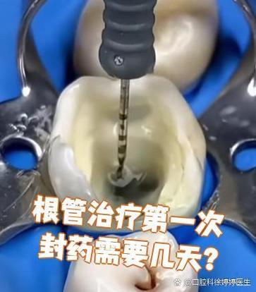 根管治疗封药的方法有哪些常见类型?不同封药材料的效果、作用机制、适用情况及注意事项有何差异?-图2 根管治疗封药的方法有哪些常见类型?不同封药材料的效果、作用机制、适用情况及注意事项有何差异?-图2