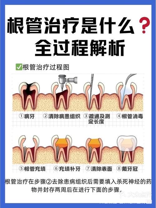 根管治疗封药的方法有哪些常见类型?不同封药材料的效果、作用机制、适用情况及注意事项有何差异?-图1 根管治疗封药的方法有哪些常见类型?不同封药材料的效果、作用机制、适用情况及注意事项有何差异?-图1