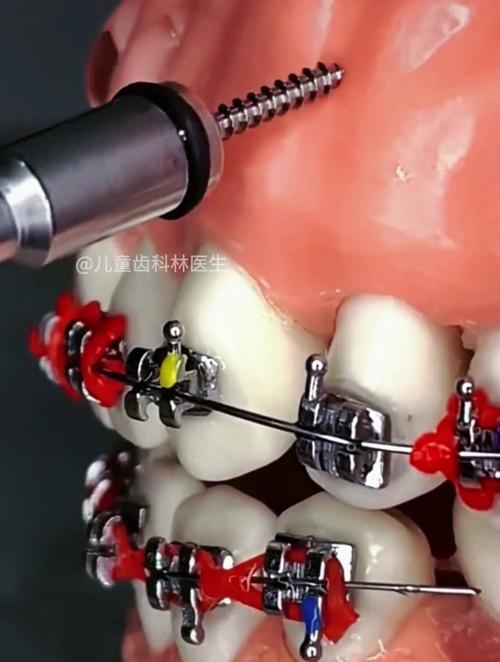 正畸微种植支抗钉究竟有哪些独特优势？相比传统支抗方式效果如何？安全性又该怎样保障？-图3