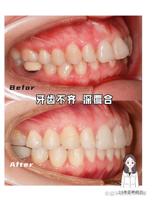 正畸后口齿不清是正常现象吗?原因是什么,会影响说话多久,该如何改善?-图2 正畸后口齿不清是正常现象吗?原因是什么,会影响说话多久,该如何改善?-图2