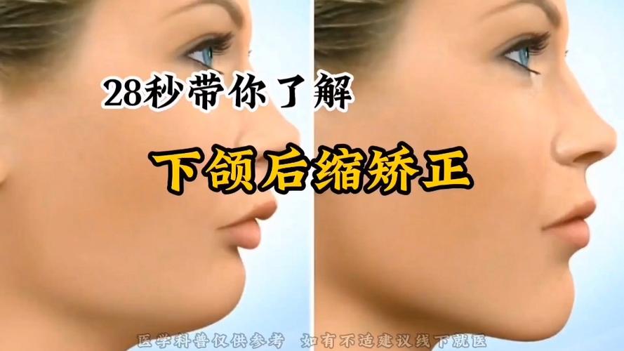 正畸治疗中如何实现下巴向外拉伸?具体矫正方法及适用情况解析?-图2 正畸治疗中如何实现下巴向外拉伸?具体矫正方法及适用情况解析?-图2