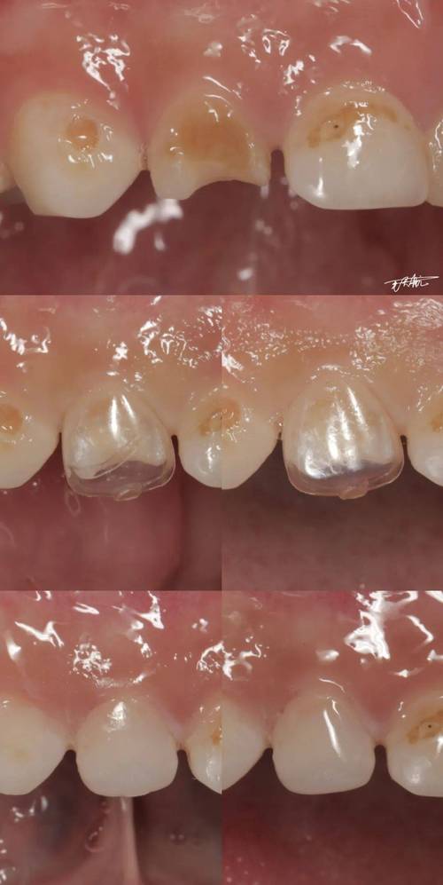 预成冠的制备方法包含哪些关键步骤?不同材料(如不锈钢、树脂)在制备工艺上有何差异,如何优化以适应儿童乳牙的特殊形态?-图2 预成冠的制备方法包含哪些关键步骤?不同材料(如不锈钢、树脂)在制备工艺上有何差异,如何优化以适应儿童乳牙的特殊形态?-图2