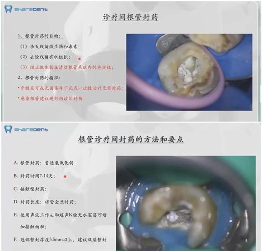 根管治疗中如何识别高风险解剖因素？有哪些规范化操作策略能显著降低侧穿发生风险？-图2