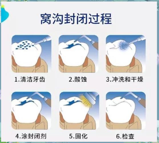 窝沟封闭操作方法的具体步骤是怎样的？操作中如何把握酸蚀时间与光照强度以确保封闭效果？-图1