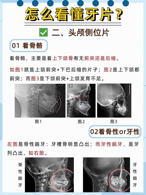 准备做牙齿正畸，需要拍哪些片子？这些影像检查分别有什么作用？-图1