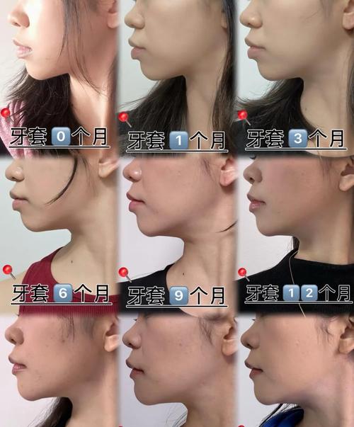 牙性龅牙正畸前后对比,矫正后牙齿排齐和侧脸改善真的能同步实现吗?矫正期间有哪些关键注意事项?-图2 牙性龅牙正畸前后对比,矫正后牙齿排齐和侧脸改善真的能同步实现吗?矫正期间有哪些关键注意事项?-图2