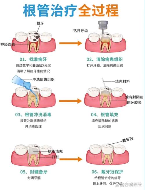 手测根管治疗中，手动检测根管长度的具体步骤和关键注意事项有哪些？-图3