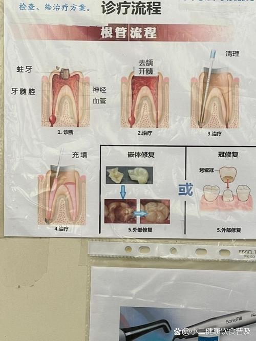 手测根管治疗中,手动检测根管长度的具体步骤和关键注意事项有哪些?-图1 手测根管治疗中,手动检测根管长度的具体步骤和关键注意事项有哪些?-图1