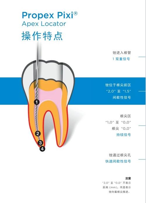 机动镍钛备根方法的关键操作技巧、常见风险及对不同弯曲度根管的适用性如何？-图3