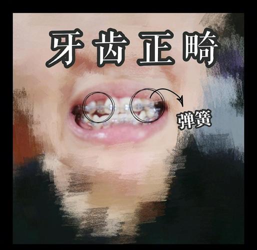 正畸治疗中保持间隙的弹簧有何关键作用?使用时需注意哪些细节才能有效防止牙齿移位?-图2 正畸治疗中保持间隙的弹簧有何关键作用?使用时需注意哪些细节才能有效防止牙齿移位?-图2