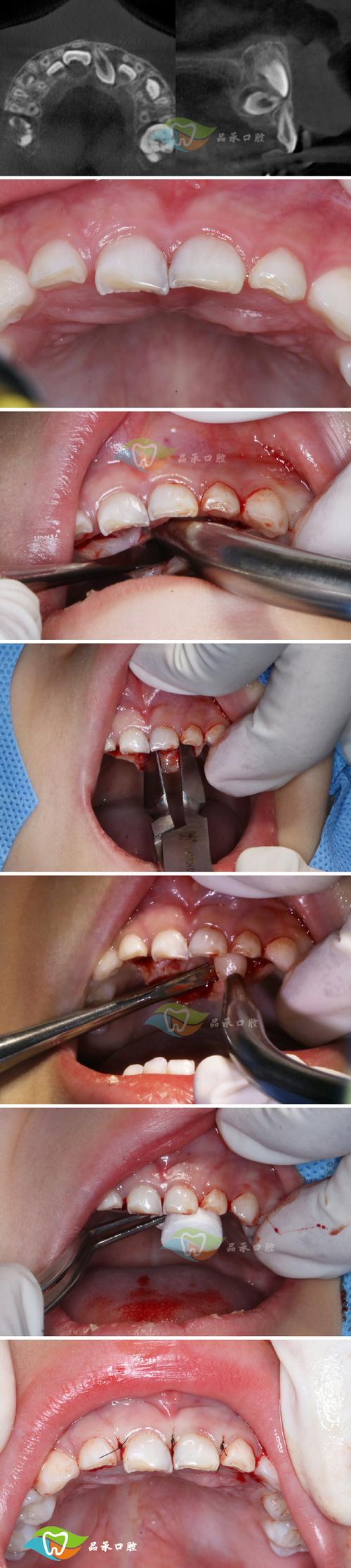 多生牙的治疗方法有哪些?不同年龄或位置的多生牙如何选择最佳治疗方案?治疗过程中需注意哪些关键事项?-图1 多生牙的治疗方法有哪些?不同年龄或位置的多生牙如何选择最佳治疗方案?治疗过程中需注意哪些关键事项?-图1