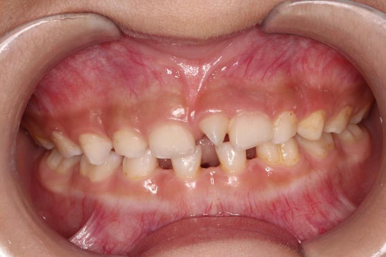 多生牙的治疗方法有哪些?不同年龄或位置的多生牙如何选择最佳治疗方案?治疗过程中需注意哪些关键事项?-图3 多生牙的治疗方法有哪些?不同年龄或位置的多生牙如何选择最佳治疗方案?治疗过程中需注意哪些关键事项?-图3