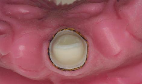 在口腔修复临床操作中，常用的排龈方法有哪些？不同方法的具体操作步骤、适应症及注意事项分别是什么？-图1