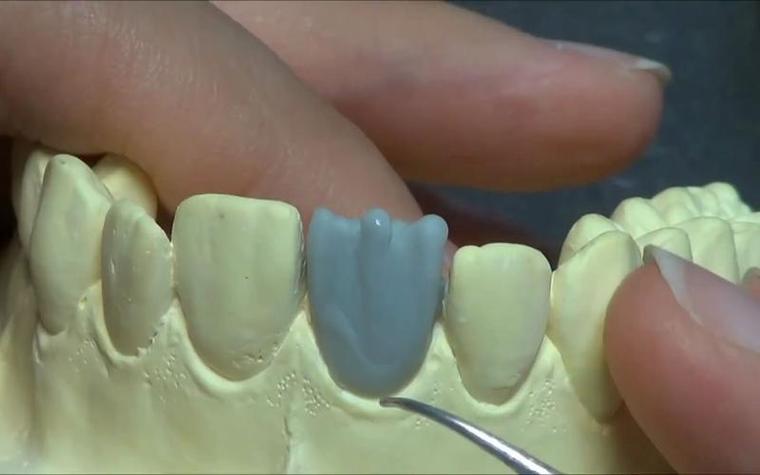 在口腔修复全冠蜡制作中,如何通过堆塑、雕刻技巧确保蜡型与患牙的精准适配及功能稳定性?-图1 在口腔修复全冠蜡制作中,如何通过堆塑、雕刻技巧确保蜡型与患牙的精准适配及功能稳定性?-图1