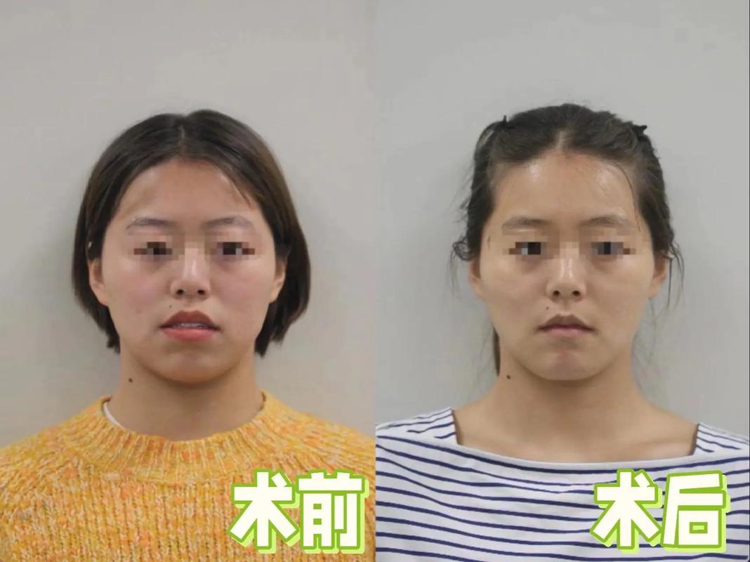 正畸联合正颌手术失败-图3