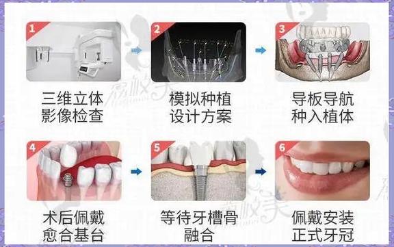 即拔即种牙的流程具体是怎样的？哪些患者适合这种治疗方式？又存在哪些潜在风险和注意事项？-图1