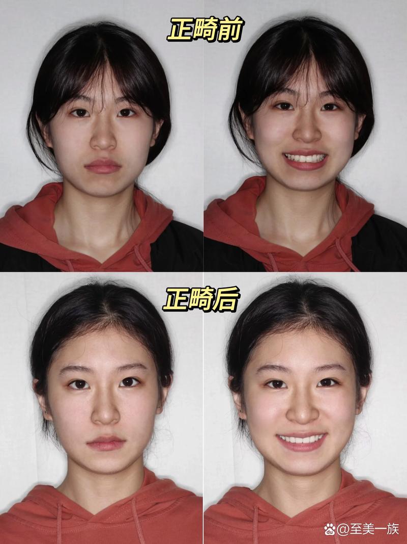 正畸面像拍摄技巧图片中,如何规范操作以获取清晰、全面的诊断影像?-图2 正畸面像拍摄技巧图片中,如何规范操作以获取清晰、全面的诊断影像?-图2