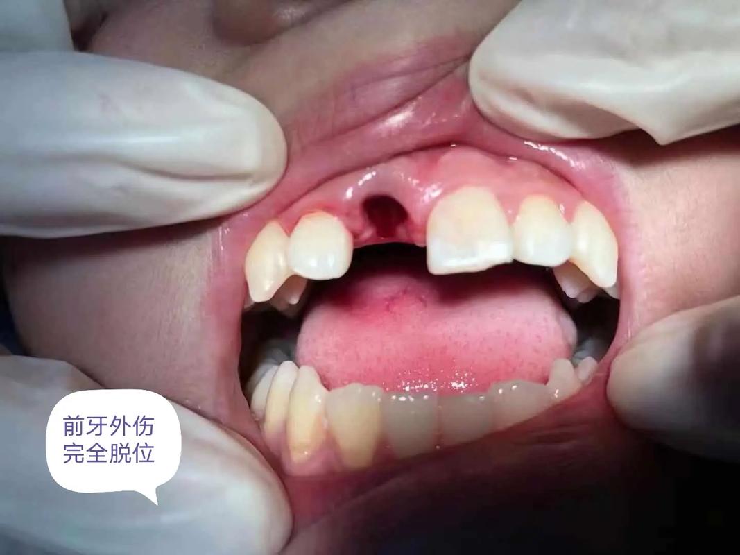 我的牙种的很成功-图2 我的牙种的很成功-图2