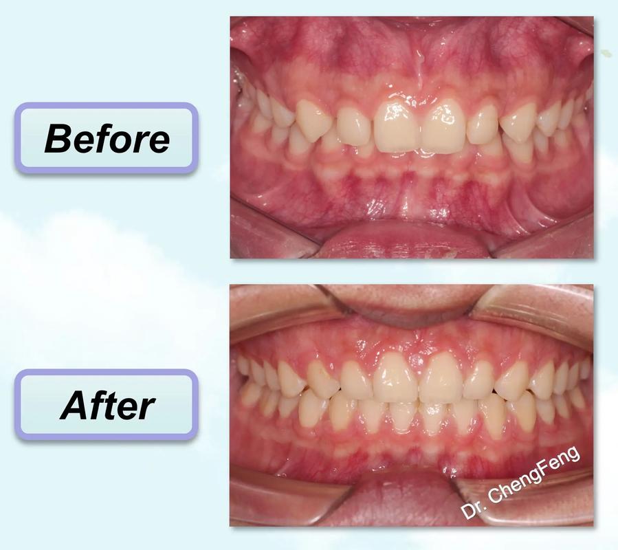 正畸后前牙睡觉时无法正常咬合，是矫正过程中的暂时反应还是异常信号？该如何应对和改善？-图2