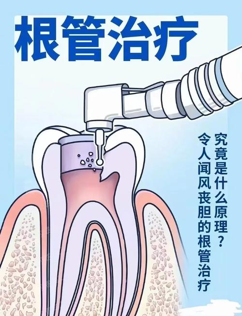 侧牙根管治疗有哪些主流方法？不同方法在适应症、操作技巧及疗效上有何差异？-图2