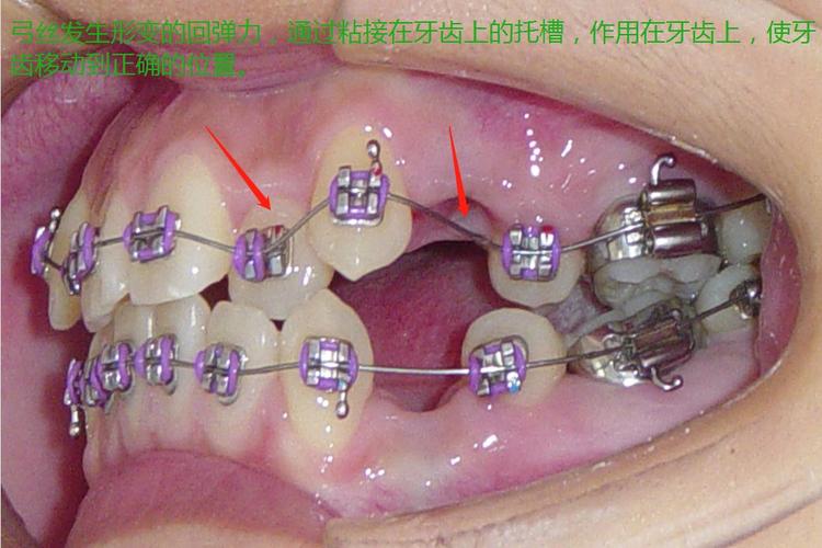 长沙天天正畸托槽图谱详细介绍了哪些托槽类型，对正畸患者选择托槽有何实际指导意义？-图3