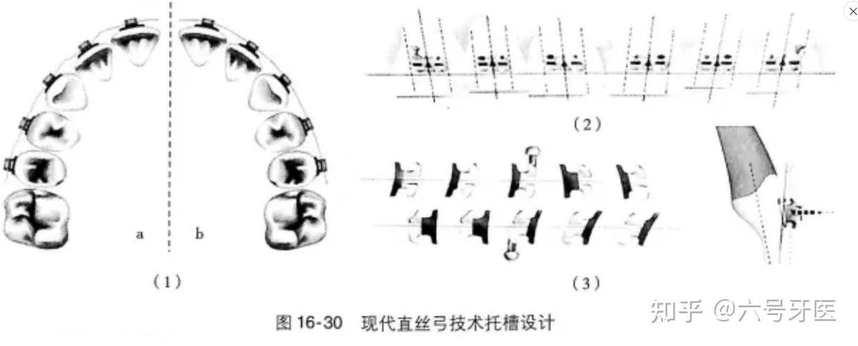 长沙天天正畸托槽图谱详细介绍了哪些托槽类型,对正畸患者选择托槽有何实际指导意义?-图1 长沙天天正畸托槽图谱详细介绍了哪些托槽类型,对正畸患者选择托槽有何实际指导意义?-图1