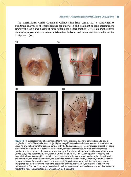 活髓牙出现龋坏或外伤时有哪些治疗方法?不同损伤程度下该如何选择,治疗后能维持多久,有哪些注意事项?-图2 活髓牙出现龋坏或外伤时有哪些治疗方法?不同损伤程度下该如何选择,治疗后能维持多久,有哪些注意事项?-图2