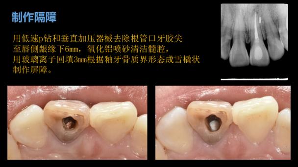 死髓牙漂白有哪些常用方法?不同技术的效果与安全性如何选择?-图2 死髓牙漂白有哪些常用方法?不同技术的效果与安全性如何选择?-图2