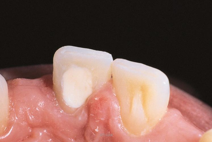 死髓牙漂白有哪些常用方法?不同技术的效果与安全性如何选择?-图1 死髓牙漂白有哪些常用方法?不同技术的效果与安全性如何选择?-图1