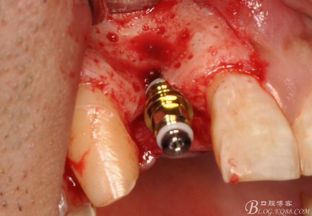 种牙摘钛网的具体过程是怎样的？手术中会有明显疼痛感吗？术后多久能恢复正常饮食？-图2