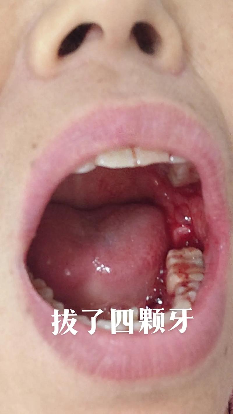 拔牙后为何要等6个月才能种牙?这段时间牙齿和牙槽床究竟在经历什么变化?-图1 拔牙后为何要等6个月才能种牙?这段时间牙齿和牙槽床究竟在经历什么变化?-图1