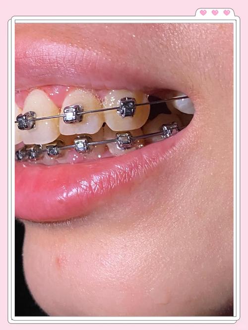 九院正颌真的不管正畸吗?正颌前必须先做正畸吗?两者治疗该如何衔接?-图1 九院正颌真的不管正畸吗?正颌前必须先做正畸吗?两者治疗该如何衔接?-图1