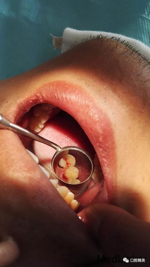 显微镜在牙齿检查中如何应用？与传统方法相比能发现哪些隐藏的牙齿问题？-图2