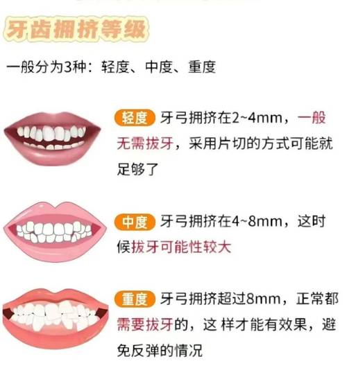 正畸前测量牙弓拥挤度时，哪些关键指标会影响矫正效果？不精准测量会导致哪些常见问题？-图1