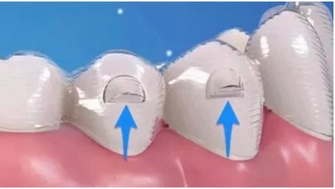 隐形正畸附件到底是什么？它在牙齿矫正中具体能发挥哪些作用？材质和设计有什么特别之处？-图2