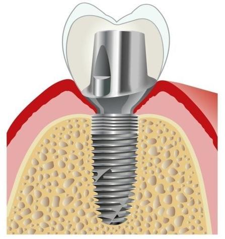 成都种牙为何选圣贝？其巨优口碑背后藏着哪些技术与服务优势？-图2