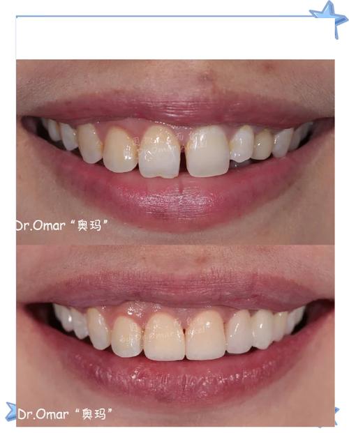 做过美容冠后还能进行正畸矫正吗？正畸过程中会影响美容冠效果或需要提前拆除吗？-图1