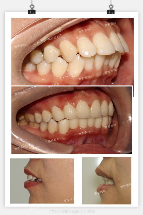 做过美容冠后还能进行正畸矫正吗？正畸过程中会影响美容冠效果或需要提前拆除吗？-图2