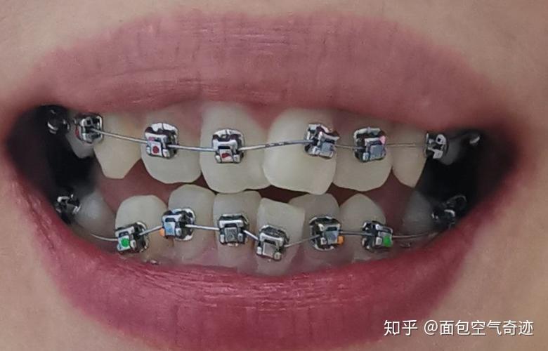 广州光华口腔医院正畸效果真的靠谱吗？不同年龄做正畸有什么区别？技术设备和医生团队如何保障效果？-图1