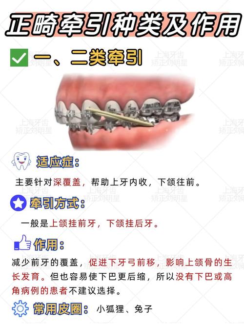 牙科正畸牵引圈的具体用法是什么?不同牙齿错颌畸形如何选择牵引方式?操作步骤和常见误区有哪些?-图1 牙科正畸牵引圈的具体用法是什么?不同牙齿错颌畸形如何选择牵引方式?操作步骤和常见误区有哪些?-图1